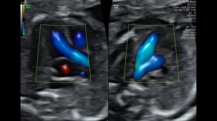 3vv And Lvot With Radiantflowtm In Dual Display